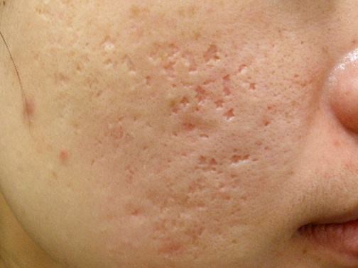 最新痘坑撫平神器，科技重塑肌膚之美，自信生活從此開始