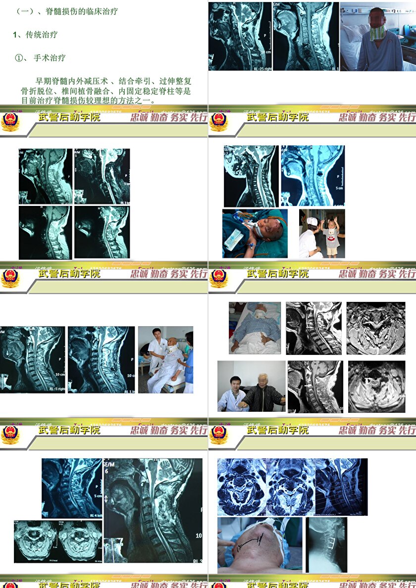 2023年脊髓損傷研究新進展，里程碑式的突破與日常奇妙變化