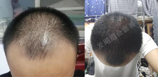 治愈脫發(fā)最新重大突破，重塑自信，希望之光再現(xiàn)